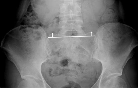 Mammillary Process Height Vertical Height Of Sacral Mammillary