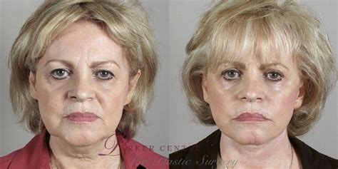 Facelift Before And After Pictures Case 23 Paramus New Jersey Parker Center For Plastic Surgery