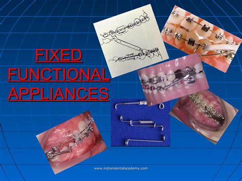 Fixed Functional Appliances Certified Fixed Orthodontic Courses By