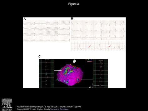 Abnormal Epicardial Electrophysiologic Substrate In Patients With Early