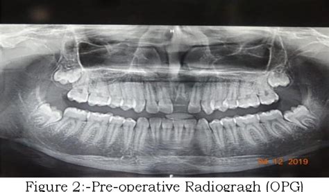 Radicular Cyst Associated With Maxillary Anterior Tooth Treated With Conservative Surgical