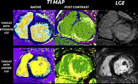 The Value Of T1 Mapping Techniques In The Assessment Of Myocardial