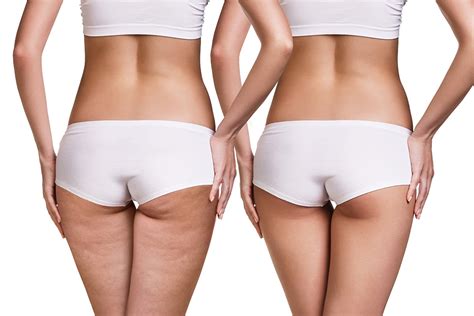 Cellulite Skin Tightening Treatment Apex Medical Spa