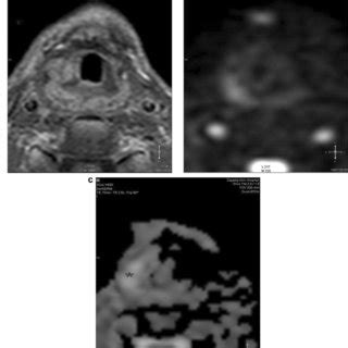 Axial Contrast Enhanced T Weighted Mr Image A Shows Heterogenously