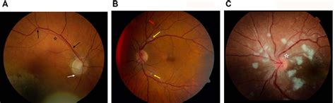 Figure From A Review Of Hypertensive Retinopathy And