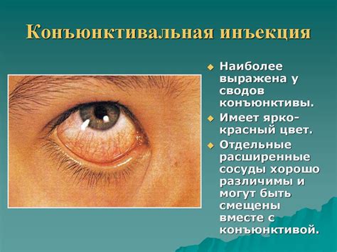 Синдром покраснения глаза - online presentation
