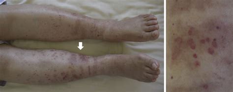 Figure1macroscopic Findings Of Purpura On Both Lower Extremities The Download Scientific