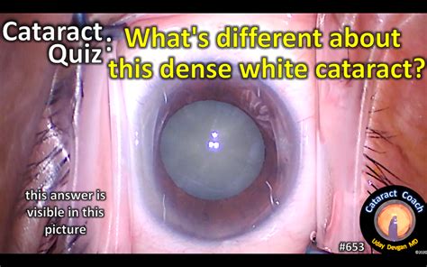 Quiz What Is Different About This Cataract Cataract Coach™