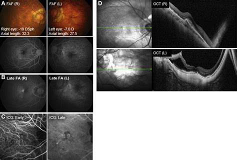 Myopic Choroidal Neovascularization Ophthalmology