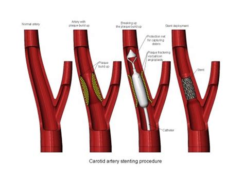 D Printable Carotid Artery Stenting Procedure Diorama Heart