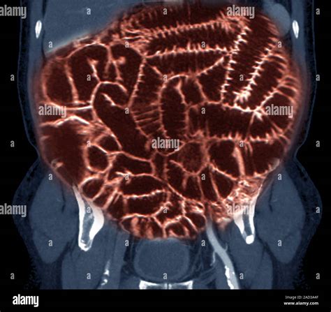 Normal Intestines In Obese Patient Coloured Magnetic Resonance Imaging