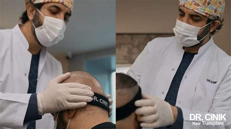 Hair Transplant Techniques: Essential Knowledge for Making the Right Choice