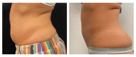 Emsculpt Neo Sherman Oaks Ca Body Contouring