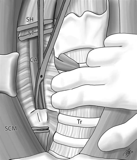 Revision Central Neck Dissection Operative Techniques In