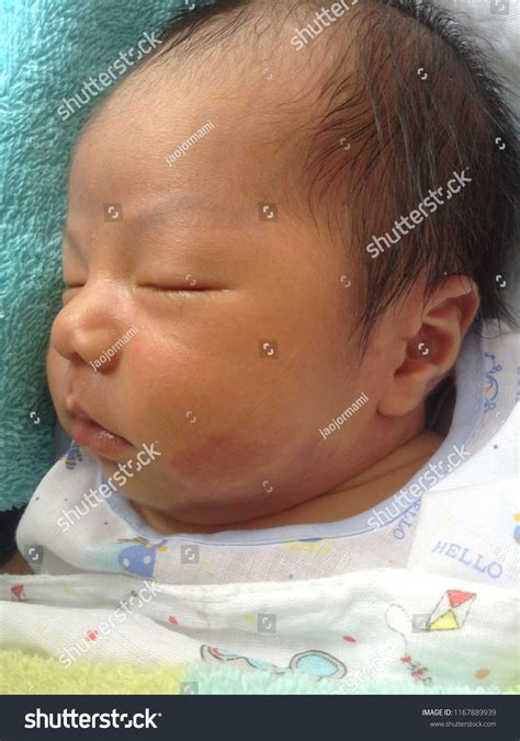 Nevus Simplex Newborn