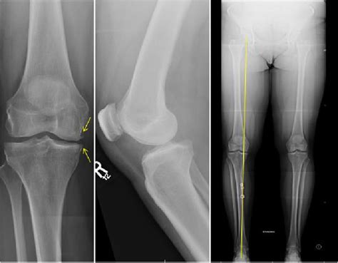 AP and lateral radiographs demonstrate mild medial joint line narrowing ...