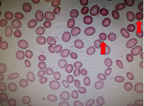 Peripheral blood smear showing small, spherical, darkly-stained red ...