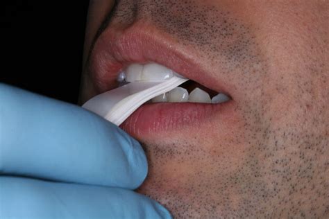 How To Care For A Dental Leaf Gauge Restorative Nation