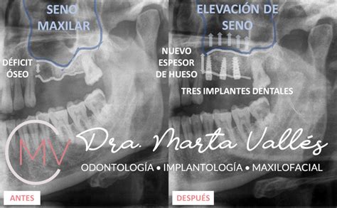 Elevación de seno maxilar resultados antes y después Clínica Dental