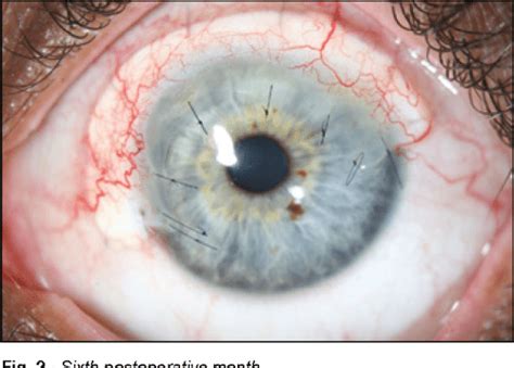 Figure 2 From Fuchs Superficial Marginal Keratitis Managed With Circumferential Marginal