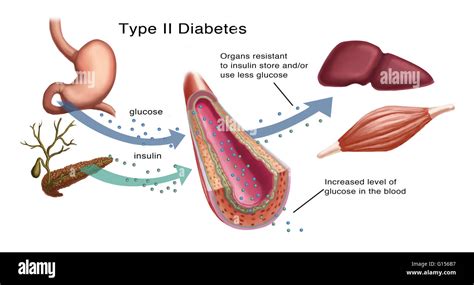 Illustration Of Insulin And Glucose Production In Type 2 Diabetes Stock