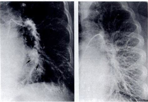 Hepatopulmonary Syndrome In 45year Old Woman With Primary Biliary Download Scientific Diagram