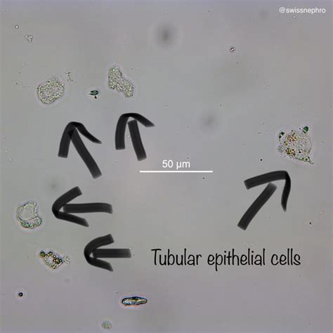 Transitional Renal Epithelial Cells In Urine