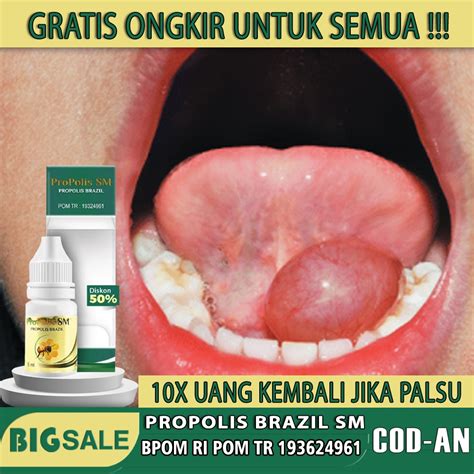 Jual Obat Herbal Penghilang Ranula Kista Benjolan Kecil Di Bawah Lidah Dasar Mulut Gusi