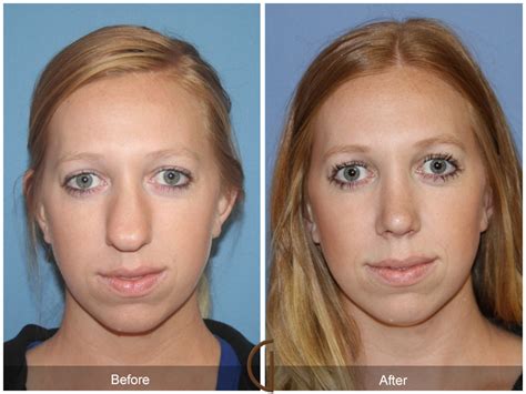 Septoplasty And Turbinate Reduction Renew Physical Therapy