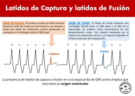 CardioTruco latidos de captura y fusión Cardioprimaria Ferrol