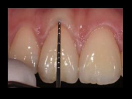 Ch 7 Mucogingival Deformities And Conditions Around Teeth Flashcards