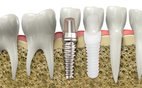 Implant Dentar Zirconiu Bucure Ti Despre Preturi Si Beneficii Click Aici