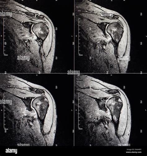 MRI image of the shoulder joint after dislocation. Impression fracture ...