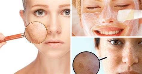 Receita E M Scara Caseira Contra Manchas De Melasma