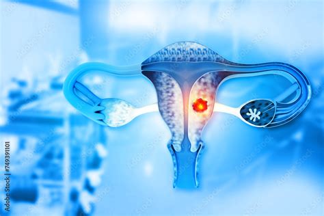 Female Reproductive System Diseases Uterus Cancer And Endometrial