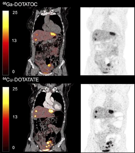 PET CT Left And PET Right Scans With 68 Ga DOTATOC And 64