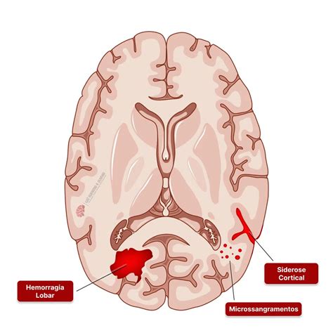 Hemorragia Cerebral AVC Hemorrágico Sintomas causas tratamentos