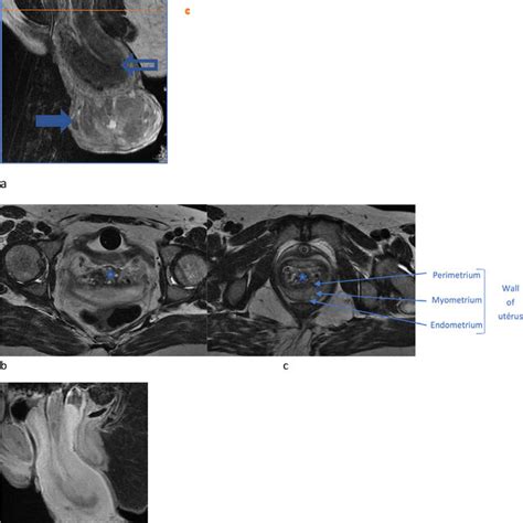 Mri Scans In Sagittal A And Axial B And C T2 Weighted And Sagittal