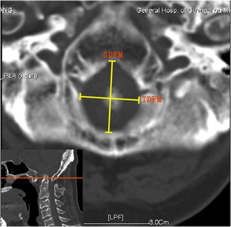 Diameter measurements of foramen magnum on CT images.: SDFM, sagittal ...