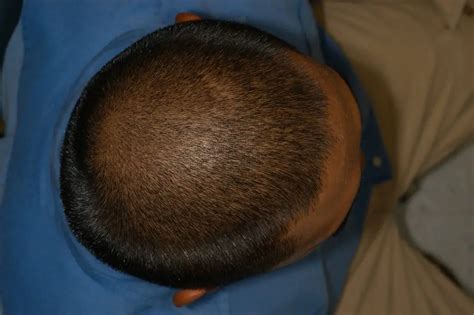 Plagiocephaly in adults: What are the consequences? | Lombafit