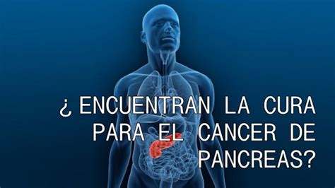 Como Curar El Cáncer De Pancreas 10 Formas Youtube