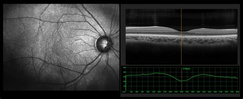 Learn About Oct And Optomap — Vision Quest Optometry Group