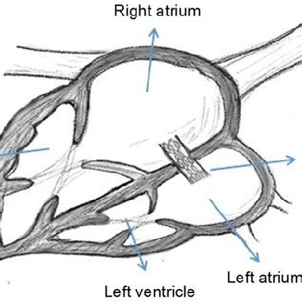 Pulmonary Valve Perforation With Catheter Inserted To Right Ventricular