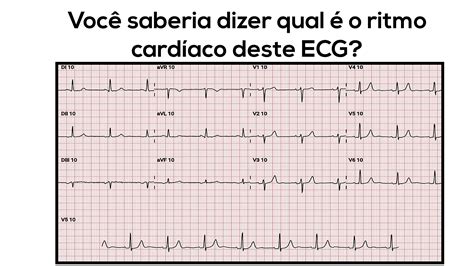 Ritmo Sinusal O Que Librain