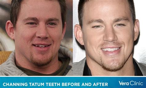 Channing Tatum Teeth Before And After Unveiling The Transformation