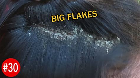 Big Flakes Dandruff Scratching Satisfying Dandruff Removal 30 Youtube