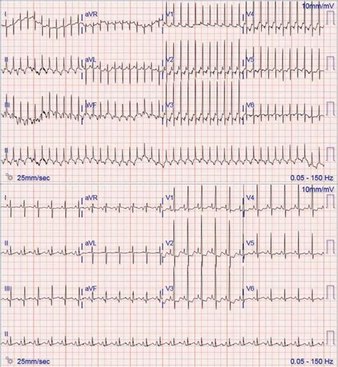 Twelve Lead Electrocardiogram From Case 2 Illustrating Supraventricular