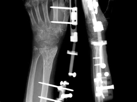 External Fixation System Acumed