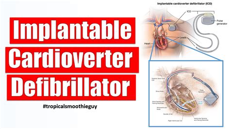 How An Implantable Cardioverter Defibrillator Works