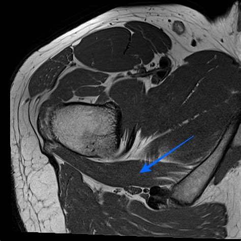 Quadratus Femoris Ct Anatomy